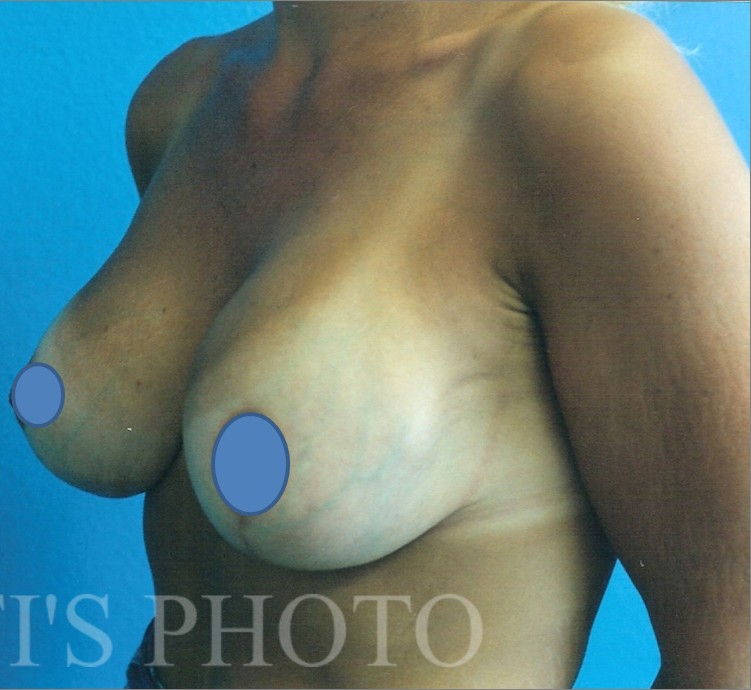 Breast Augmentation before and after - after