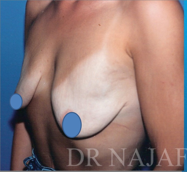 Breast Augmentation before and after - before
