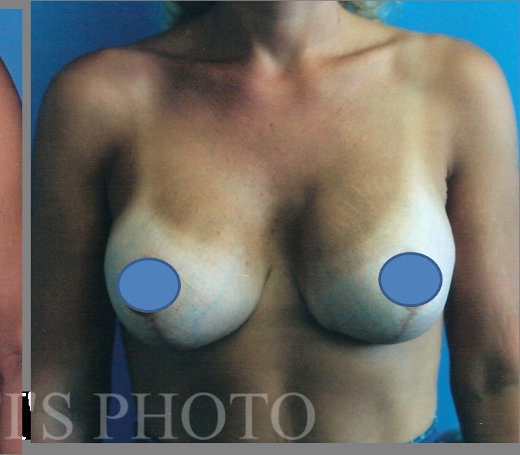 Breast Augmentation before and after - after