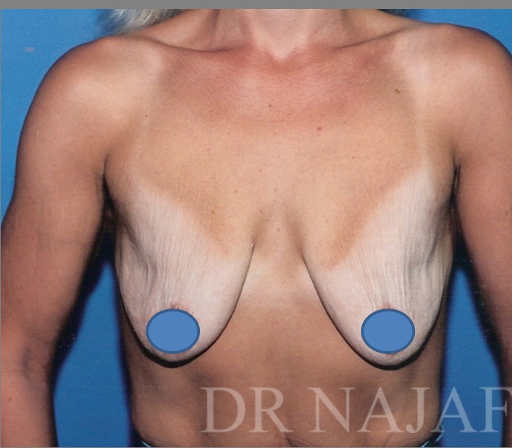 Breast Augmentation before and after - before