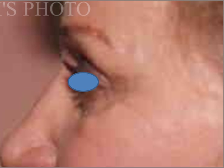 Blepharoplasty before and after - after