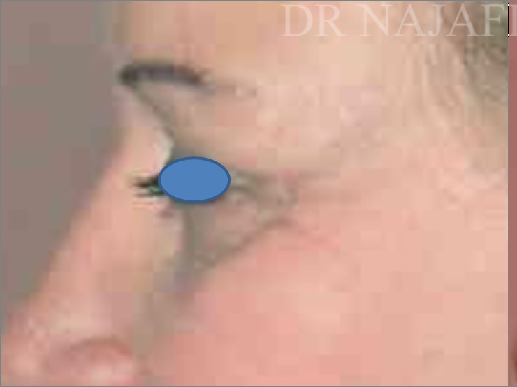 Blepharoplasty before and after - before