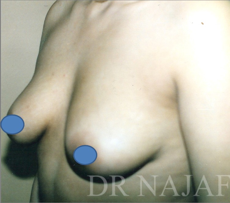 Breast Augmentation before and after - before