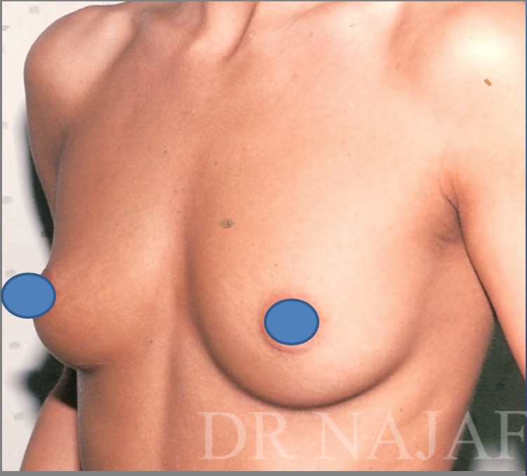 Breast Augmentation before and after - before