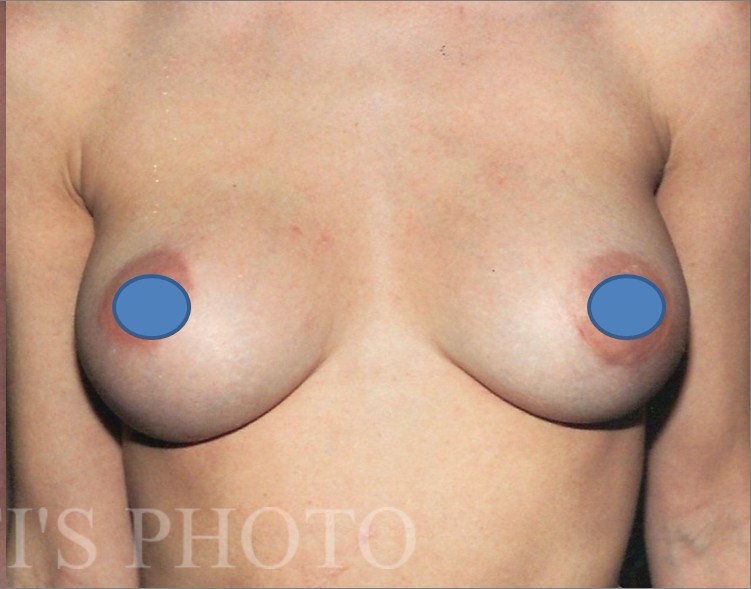 Breast Augmentation before and after - after