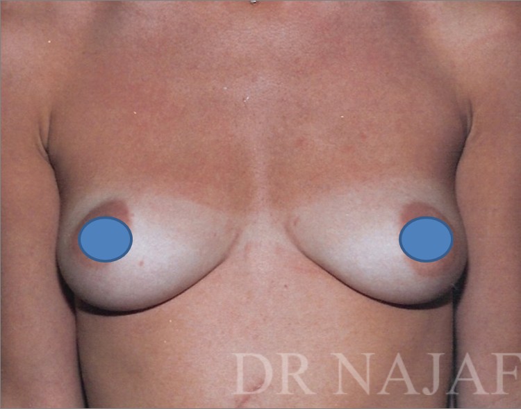 Breast Augmentation before and after - before