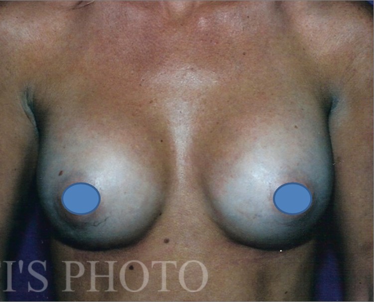 Breast Augmentation before and after - after