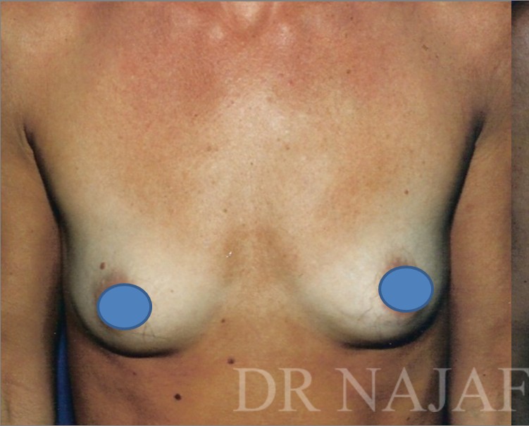 Breast Augmentation before and after - before