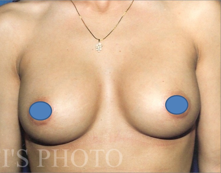 Breast Augmentation before and after - after