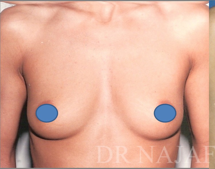 Breast Augmentation before and after - before