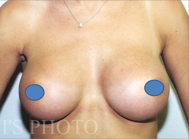 Breast Augmentation before and after - after