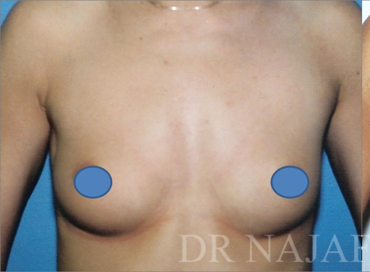 Breast Augmentation before and after - before