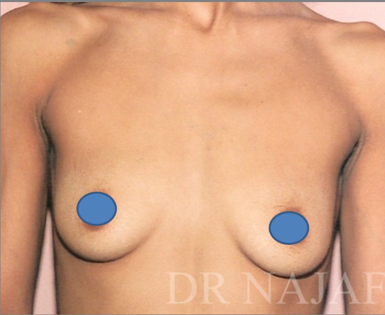 Breast Augmentation before and after - before