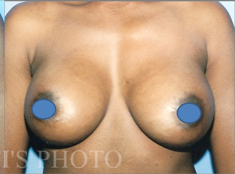 Breast Augmentation before and after - after