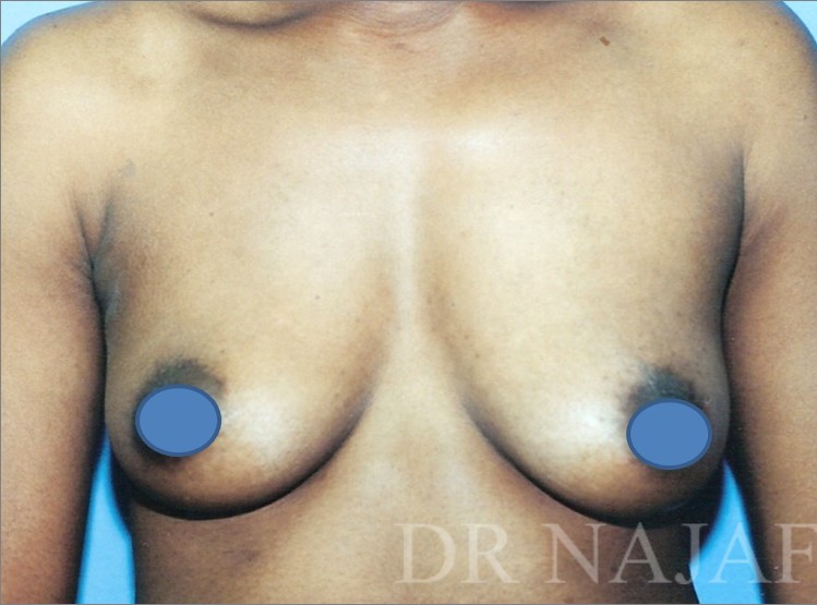 Breast Augmentation before and after - before