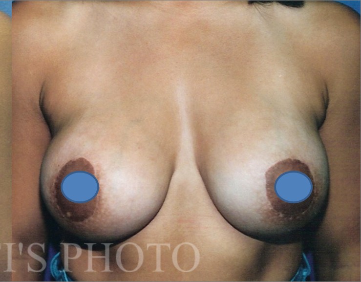 Breast Augmentation before and after - after