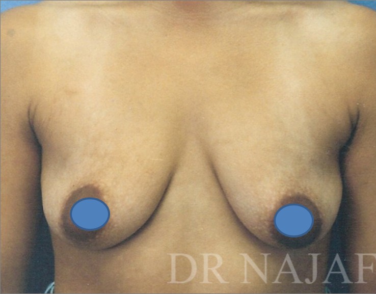 Breast Augmentation before and after - before