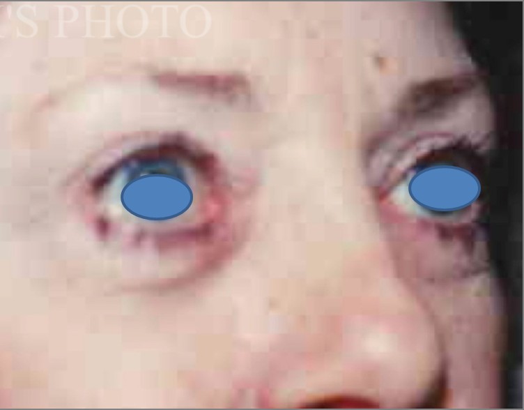 Blepharoplasty before and after - after