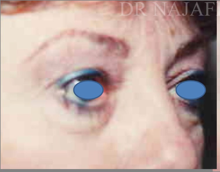 Blepharoplasty before and after - before