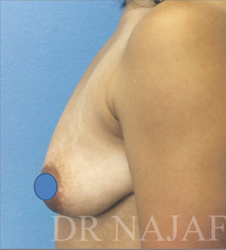 Breast Augmentation before and after - before