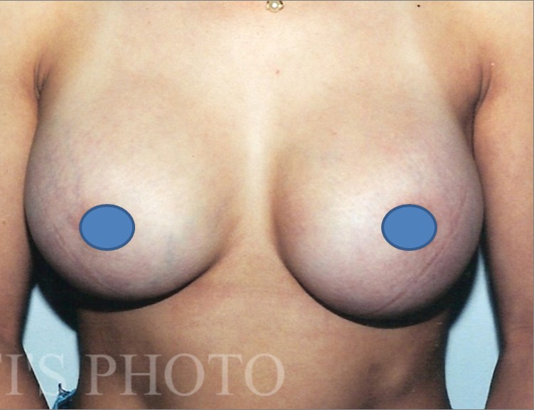Breast Augmentation before and after - after