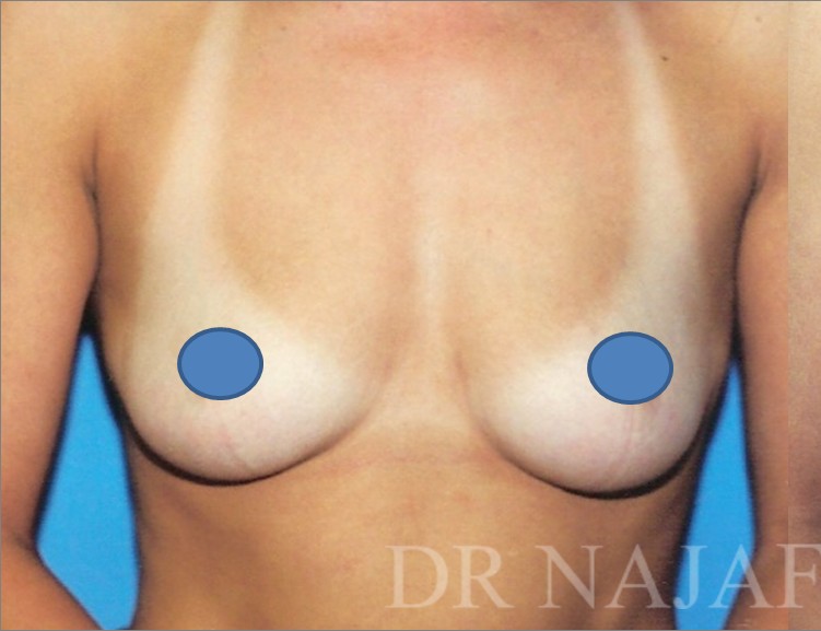Breast Augmentation before and after - before