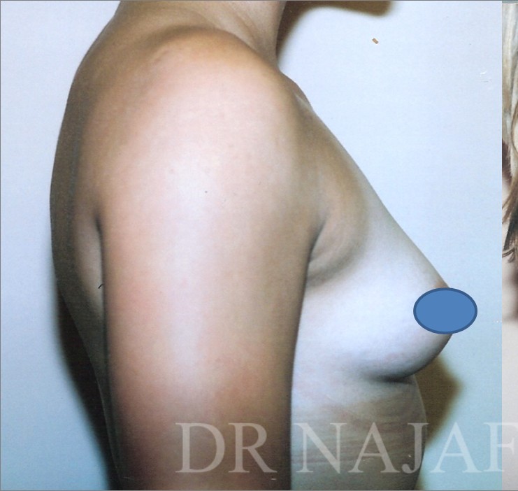 Breast Augmentation before and after - before