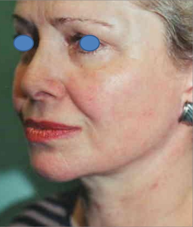 Facelift after — Dr. Hossein Najafi