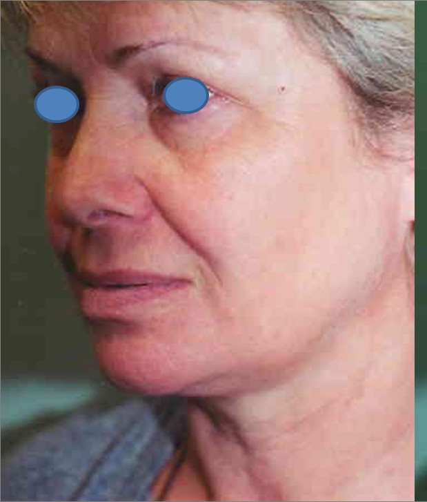 Facelift before — Dr. Hossein Najafi