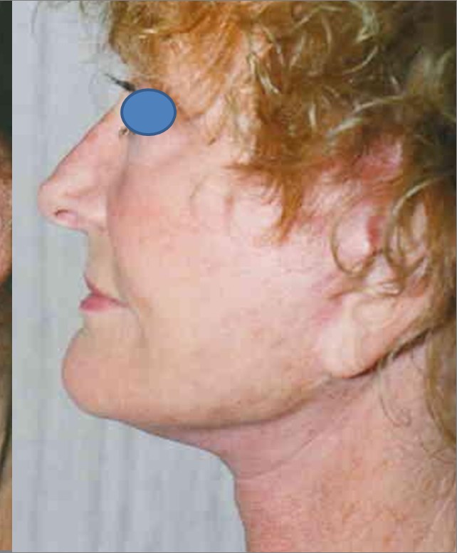 Facelift after — Dr. Hossein Najafi