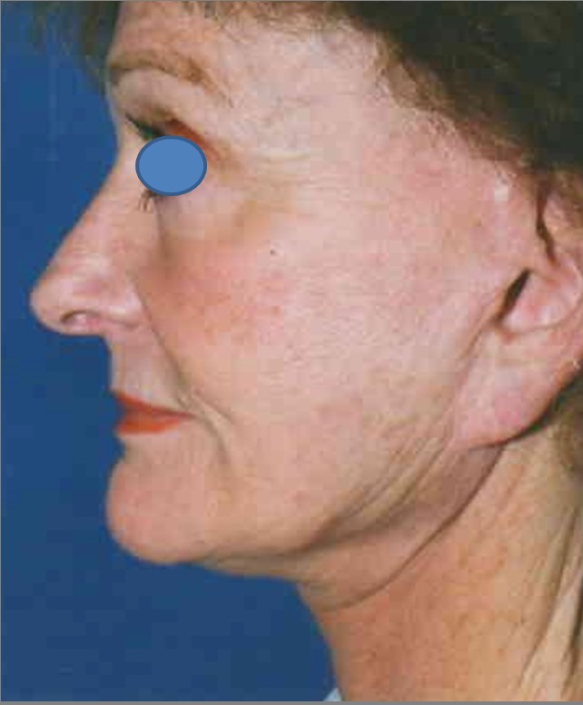 Facelift before — Dr. Hossein Najafi