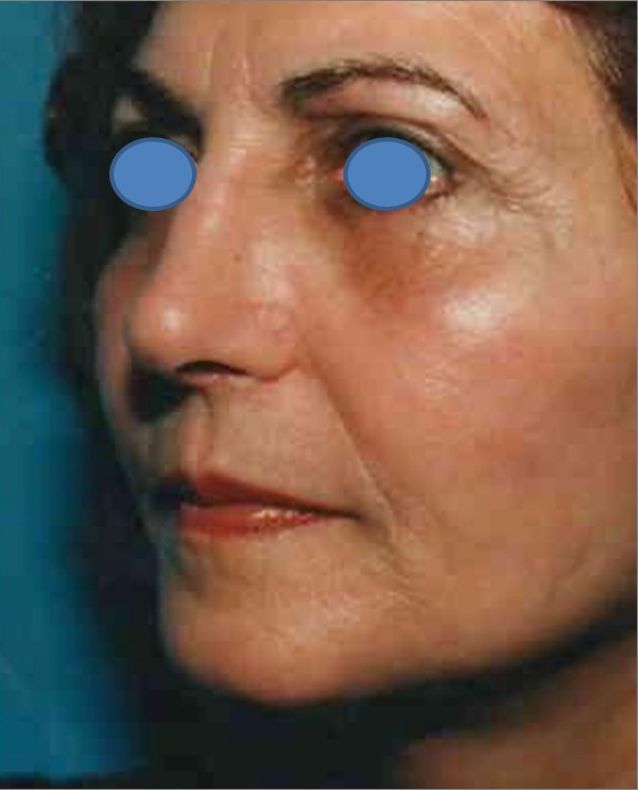 Facelift after — Dr. Hossein Najafi