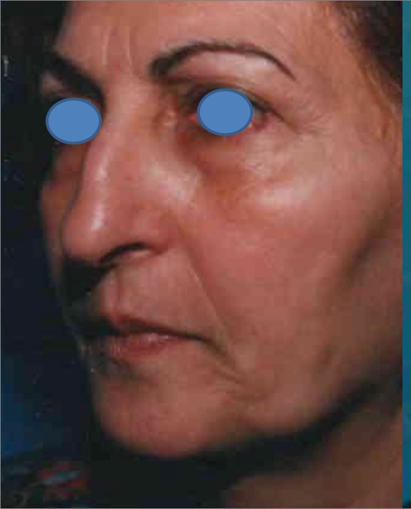 Facelift before — Dr. Hossein Najafi