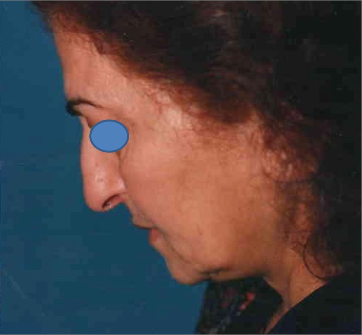 Facelift after — Dr. Hossein Najafi