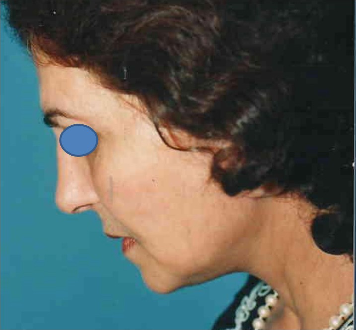Facelift before — Dr. Hossein Najafi