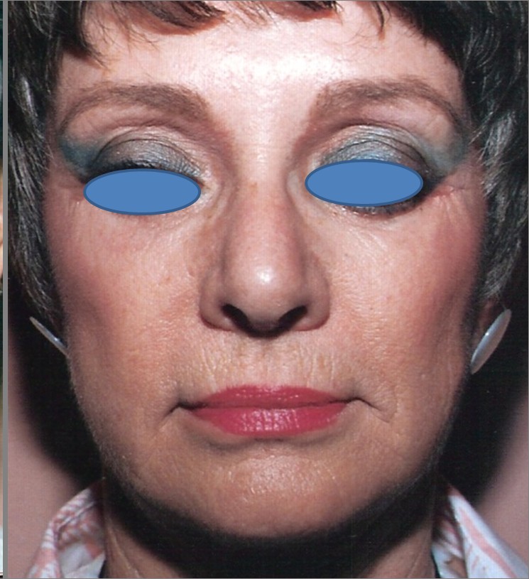 Facelift after — Dr. Hossein Najafi
