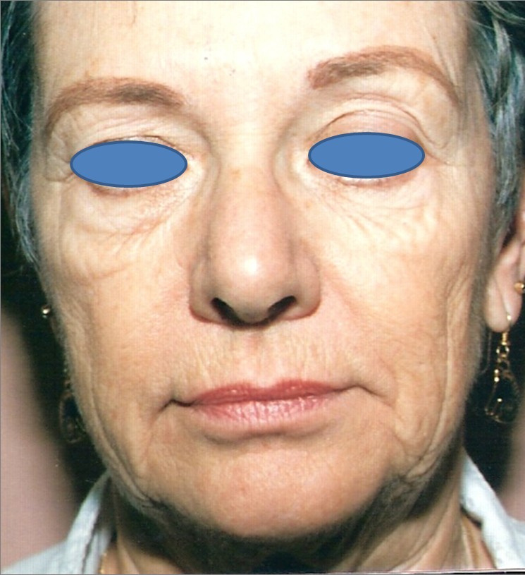 Facelift before — Dr. Hossein Najafi