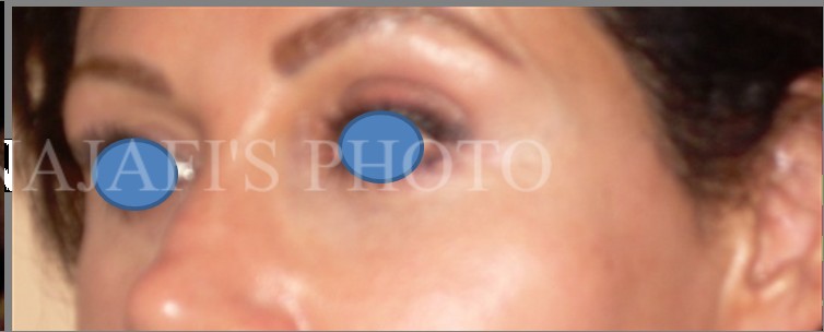 Facelift after — Dr. Hossein Najafi
