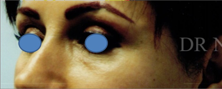 Facelift before — Dr. Hossein Najafi