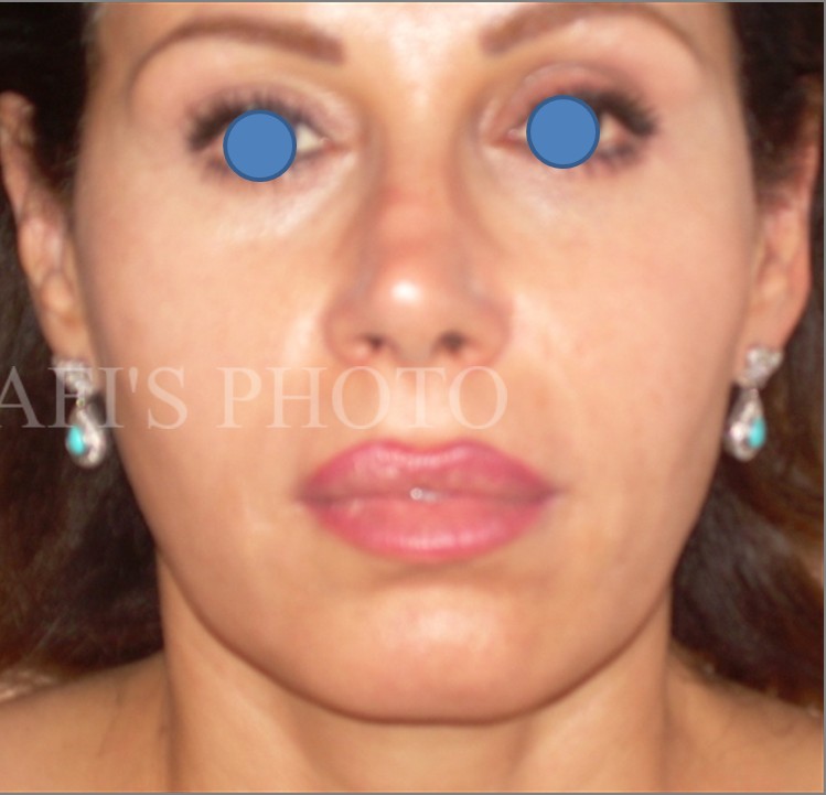 Facelift after — Dr. Hossein Najafi