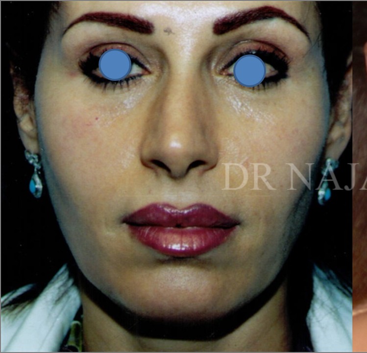 Facelift before — Dr. Hossein Najafi