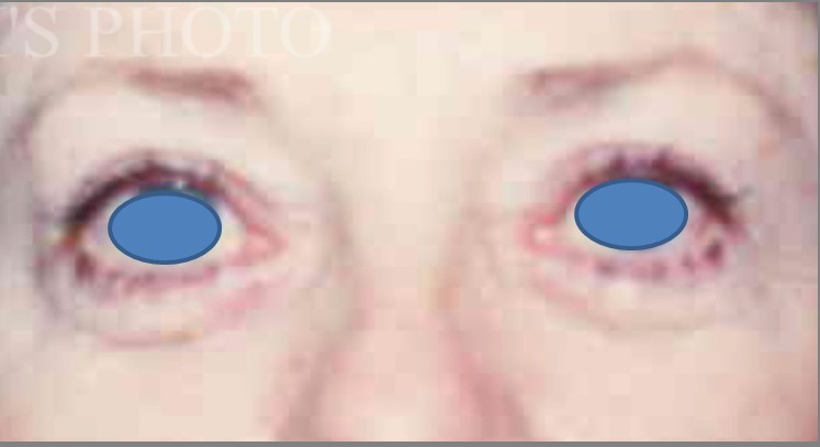 Blepharoplasty before and after - after