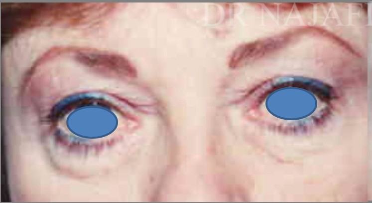 Blepharoplasty before and after - before