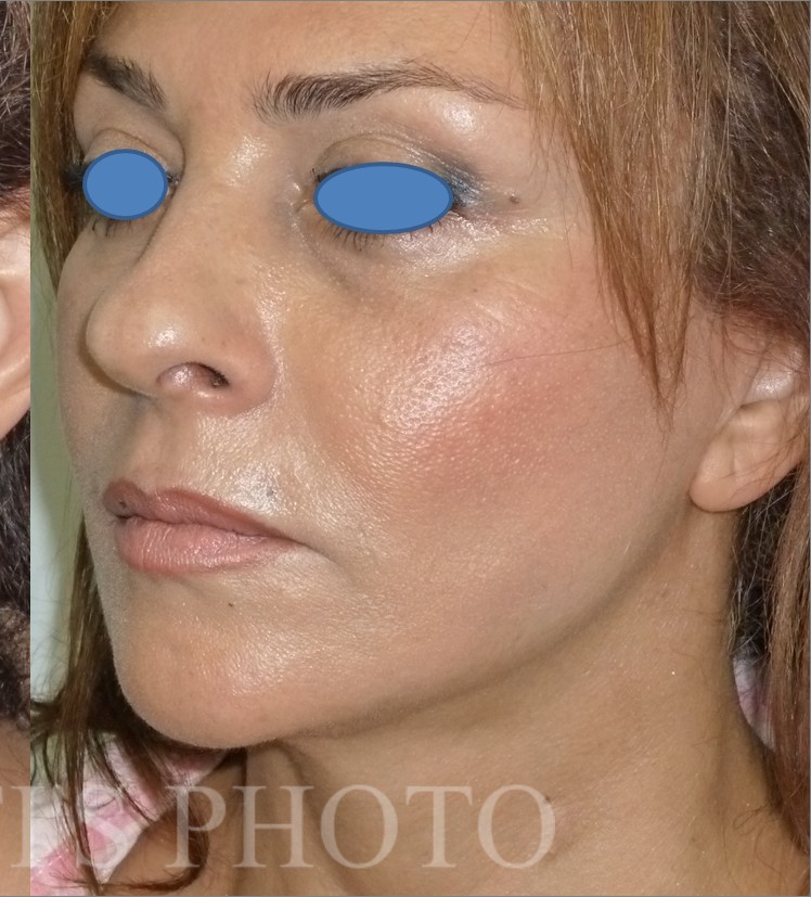 Facelift after — Dr. Hossein Najafi
