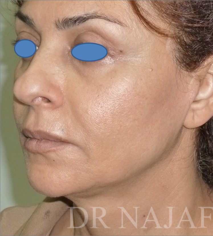 Facelift before — Dr. Hossein Najafi