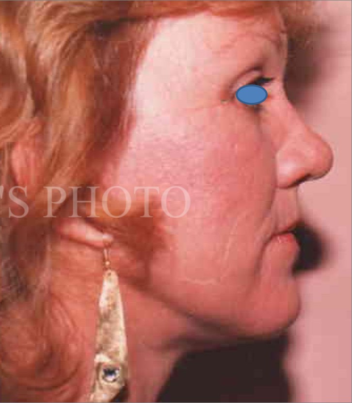 Facelift after — Dr. Hossein Najafi