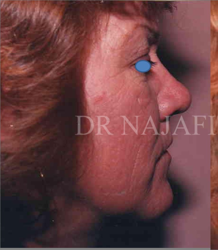 Facelift before — Dr. Hossein Najafi