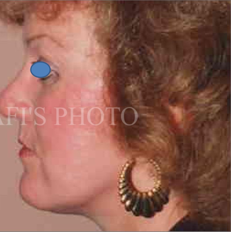 Facelift after — Dr. Hossein Najafi