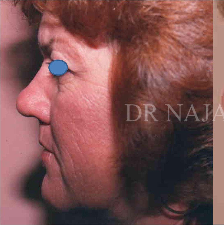 Facelift before — Dr. Hossein Najafi