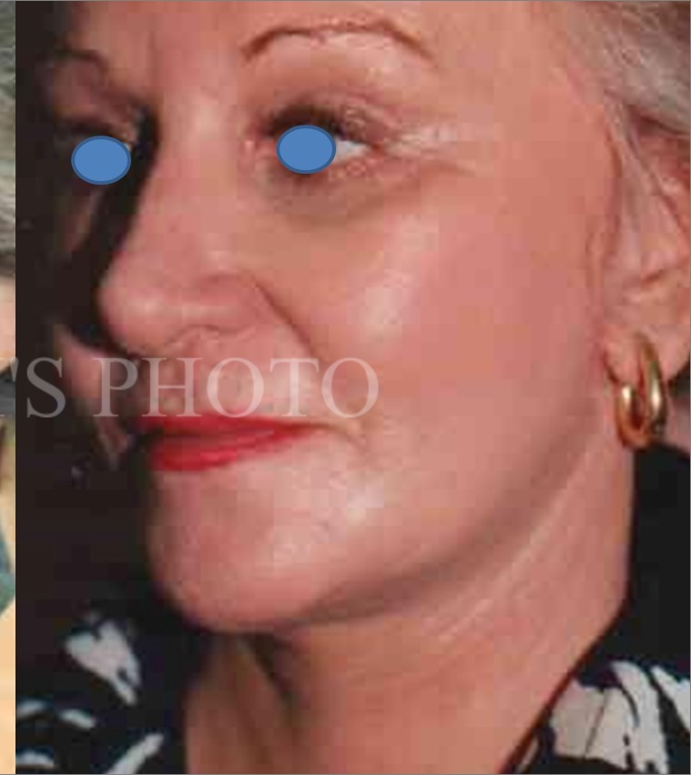 Facelift after — Dr. Hossein Najafi